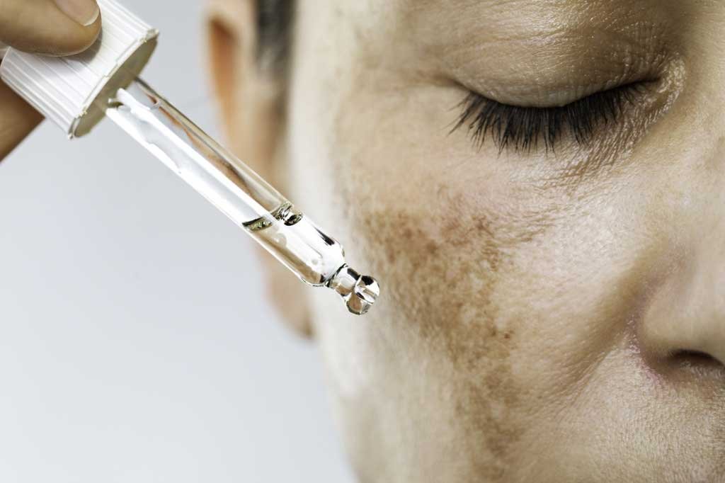 Tratamento Melasma Sérum